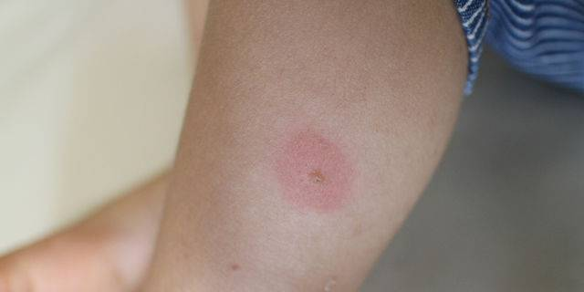 虫に刺されたところ、黒くなる！担当:薬局