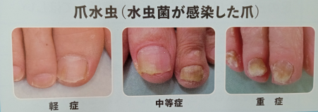 爪白癬（爪水虫）